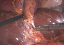 Cholécystectomie laparoscopique - Ablation mini-invasive de la vésicule [VIDEO]