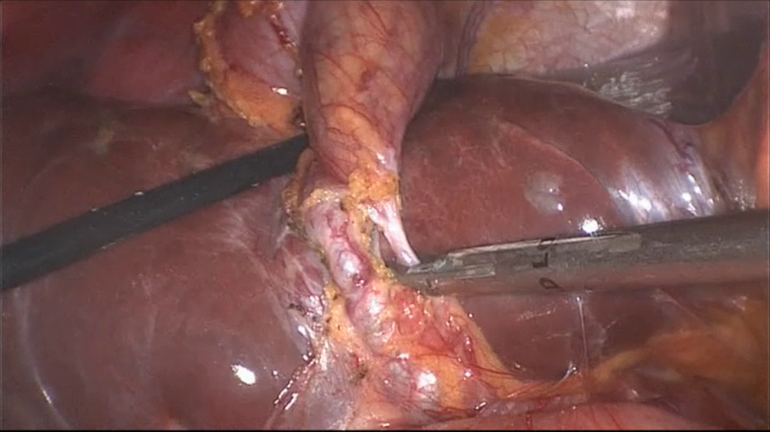Cholécystectomie laparoscopique - Ablation mini-invasive de la vésicule [VIDEO]